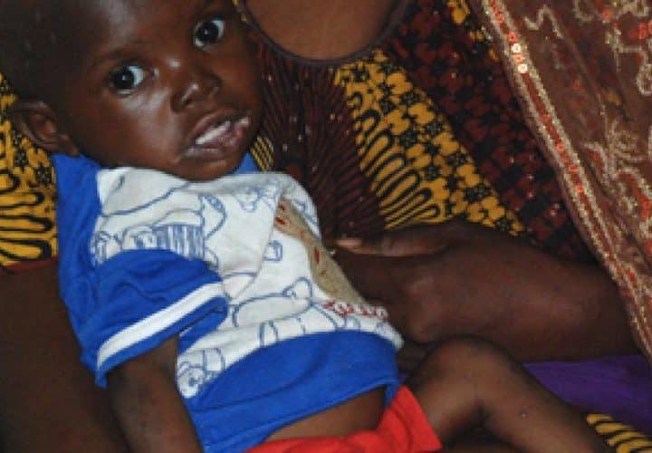 Enfant malien touché par la malnutrition, illustrant la crise sanitaire